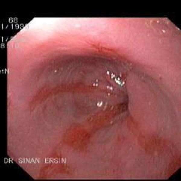 Reflüye bağlı Grade B Özofajit - 2