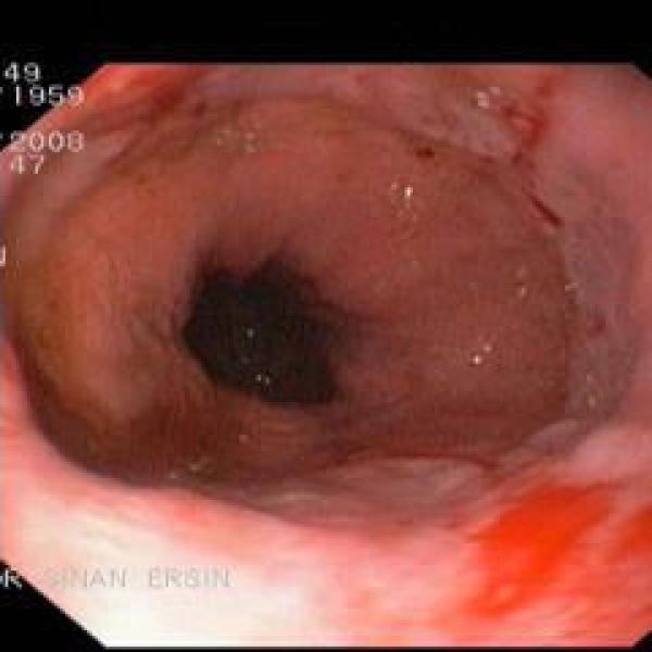 Reflüye bağlı Grade B Özofajit - 1