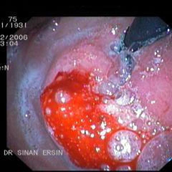 Stomach Tumor - 1