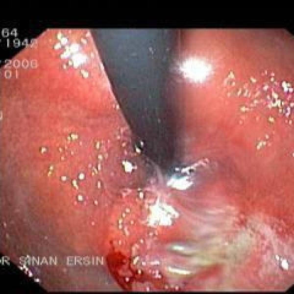 Stomach Tumor - 2