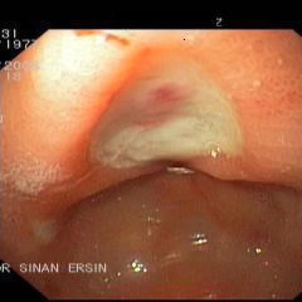 Ulcer in the stomach - 3