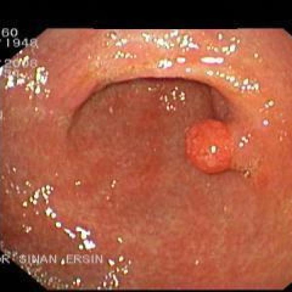 Polyp in the stomach - 4